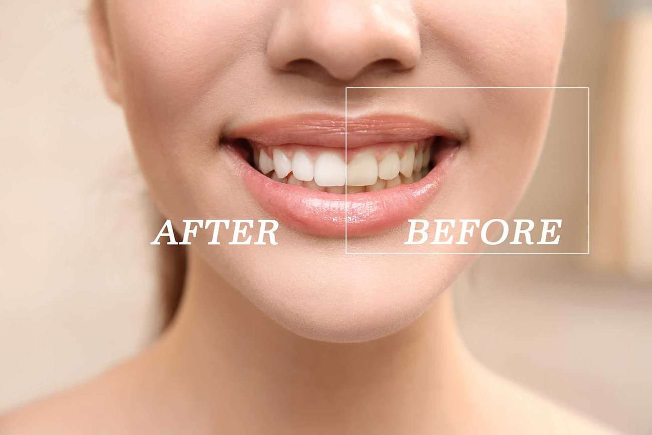 What Are the Most Effective Natural Teeth Whitening Methods You Can Try Hove?