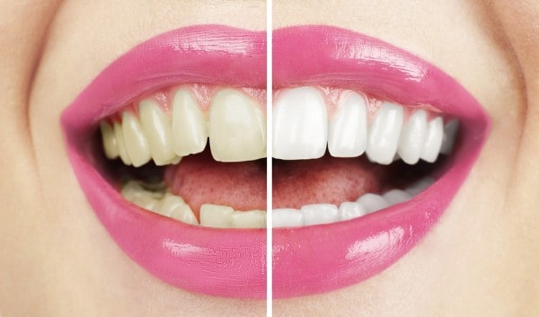 What Makes Ultima White Teeth Whitening Different Hove