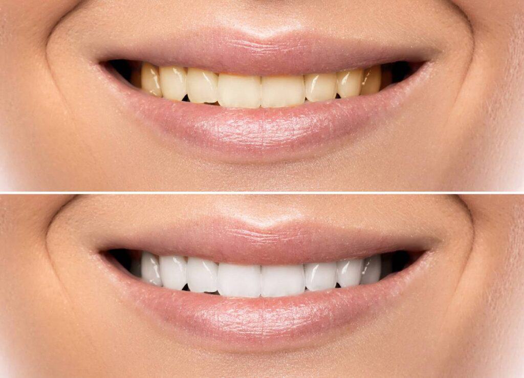 How Can You Protect Your White Smile as a Coffee Lover Hove?