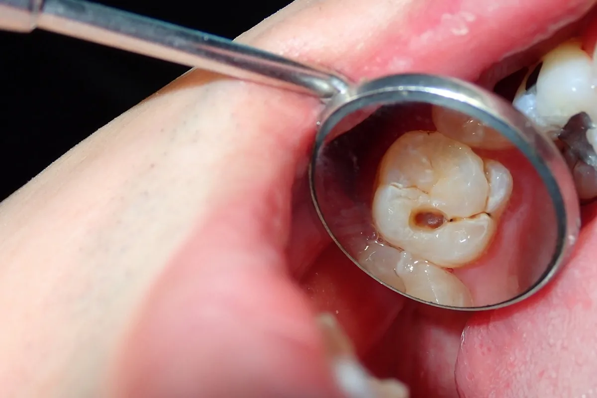 Why Do Teeth Crack? Common Causes to Know Hove