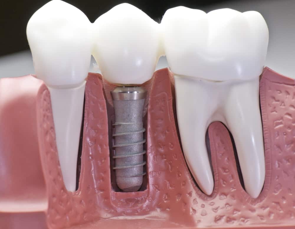 Common Misconceptions About Modern Dental Treatments Hove