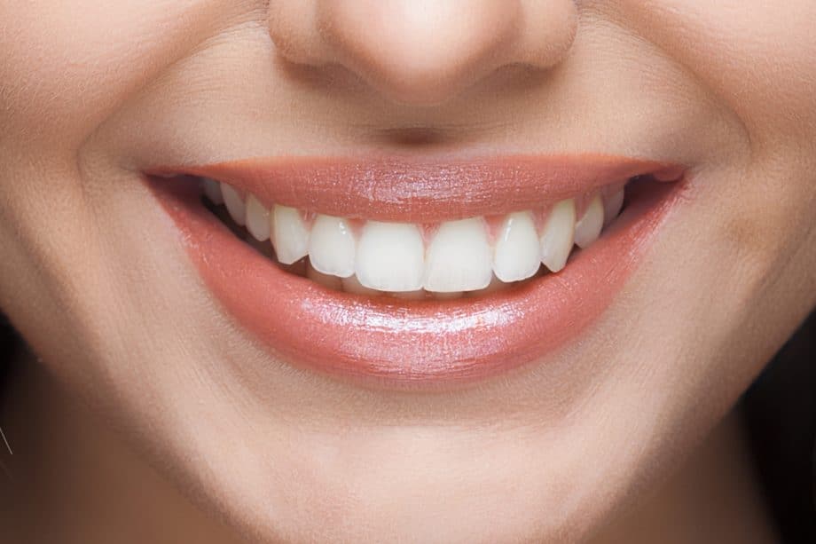 Why Do Some Teeth Whitening Results Fade Faster Than Others Hove?