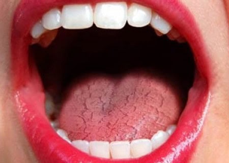 Common Causes of Dry Mouth (Xerostomia) Hove