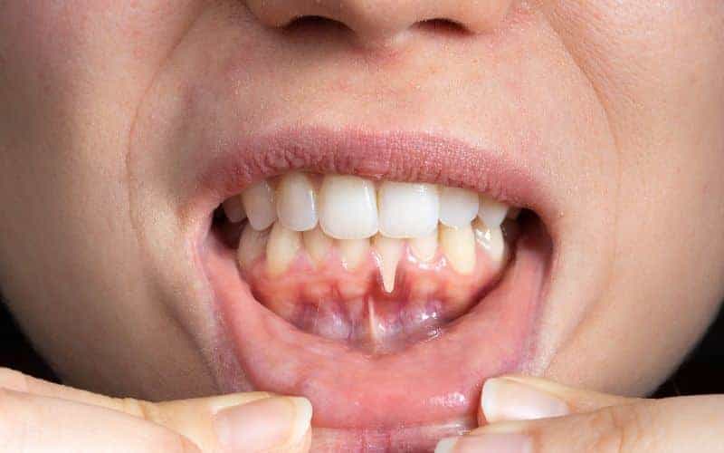 How Can Gum Disease Be Prevented Hove?