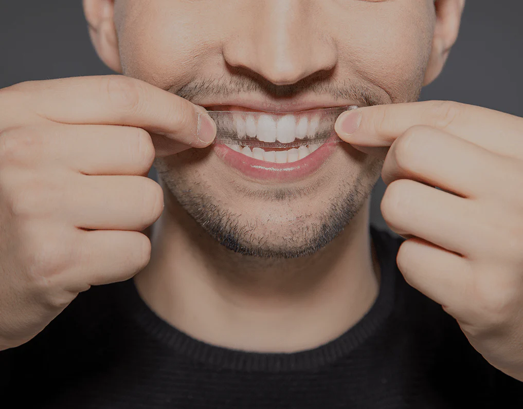 What to Consider Before Choosing a Teeth Whitening Option Hove