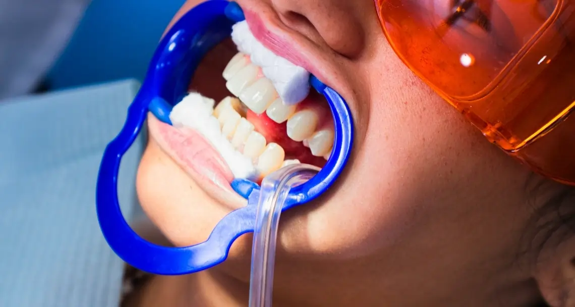 How Teeth Whitening Treatments Actually Work on Your Enamel Hove