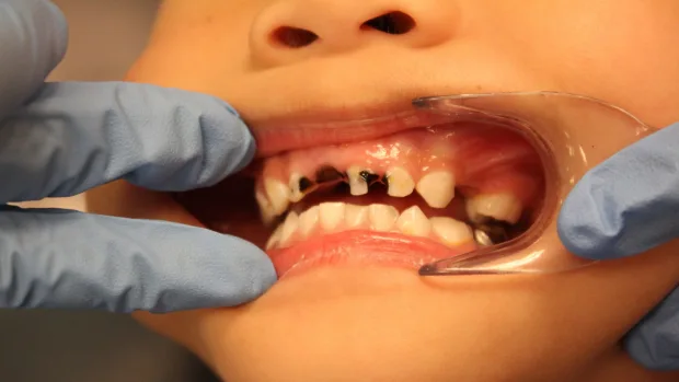 Can Your Diet Help You Achieve a Whiter, Healthier Smile Hove?