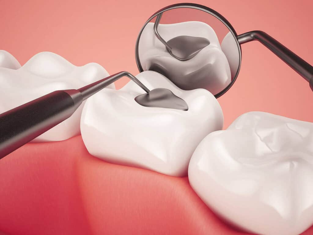 Fighting Cavities and Plaque Buildup Hove