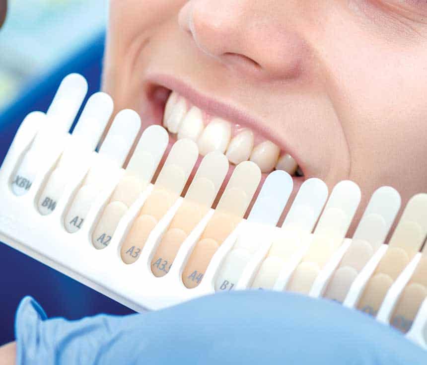 Professional vs At-Home Whitening: What You Need to Know Hove