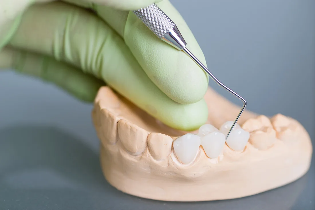 Do Braces Take Years to Show Results Hove