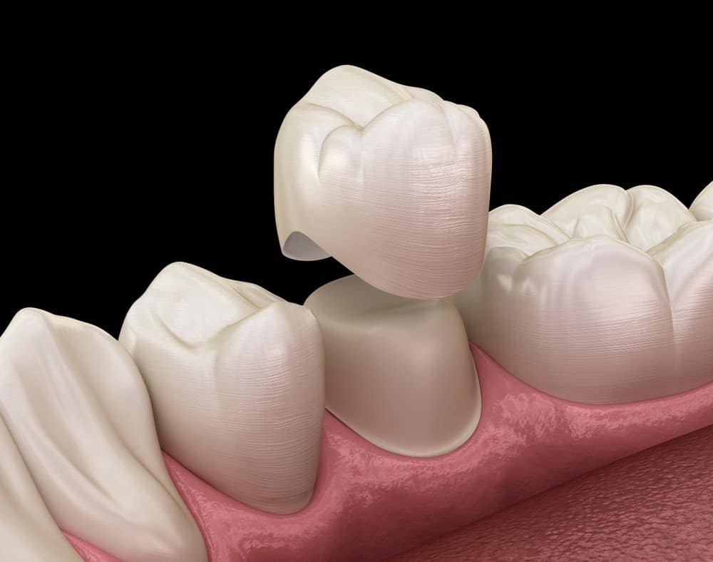 Teeth Whitening: Separating Facts from Fiction Hove