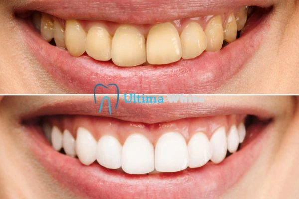Why Might Multiple Whitening Sessions Be Necessary Hove?