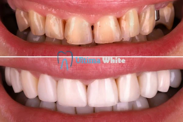 What Makes Instant Teeth Whitening Treatments So Popular Hove?