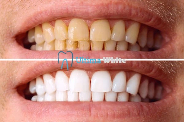 Stained Teeth and Persistent Bad Breath Hove
