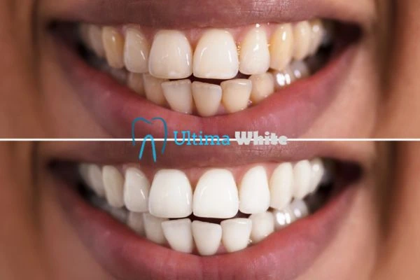 Long lasting results from Ultima White Hove
